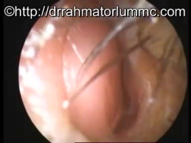 Nasal septum deviation - DNS