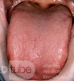 Normal Tongue
