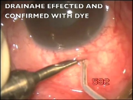 Transciliary filtration in the surgery of acute glaucoma