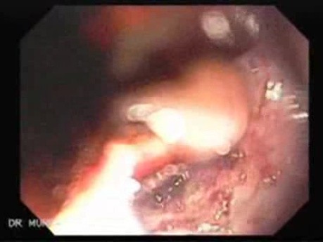Severe Bleeding of the Upper Digestive System After Two Days of Band Ligation - Complication