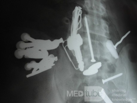 Multiple Foreign bodies in the GI tract (9 of 12)