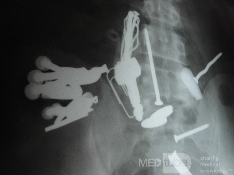 Multiple Foreign bodies in the GI tract (9 of 12)