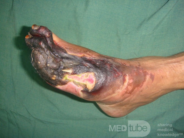 Neglected ischemic diabetic foot1