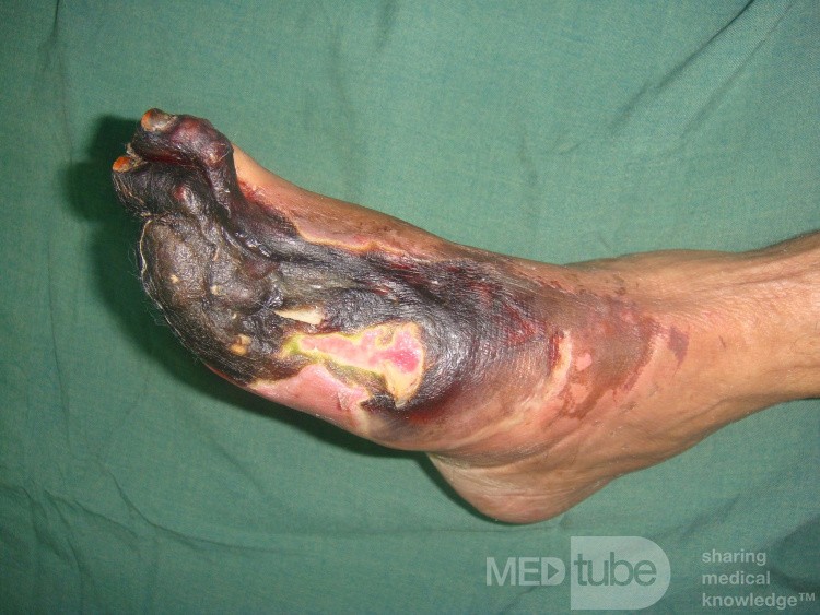 Neglected ischemic diabetic foot1