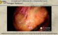 Adding to the Omental Repertoire - Minimally Invasive Omental Flap Harvest for Extremity Lymph Node Transfer