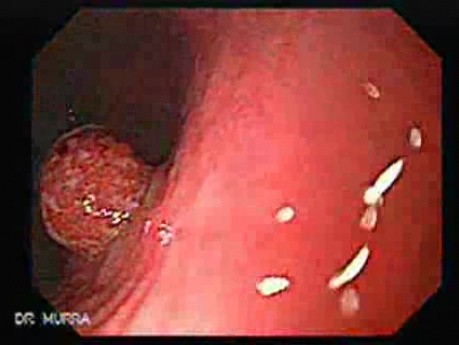 Hyperplastic Polyps - Endoscopy (1 of 14)
