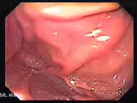 The Gastric Body - Rugal Folds In Retroflexed View (3 of 6)