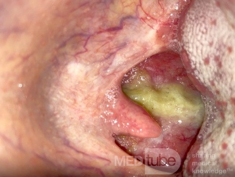 Purulent Postnasal Discharge
