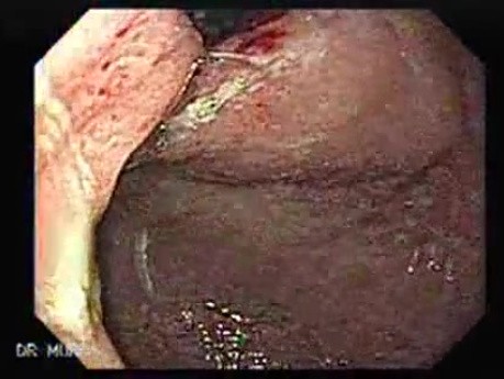 Adenocarcinoma of the Cardias - Main Lesion In the Gastric Fundus, Retroflexed View