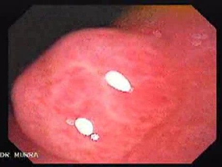 Gastric Polyp (4 of 7)