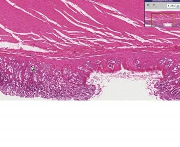 Stomach - Erosion