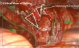 Critical View of Safety in LC
