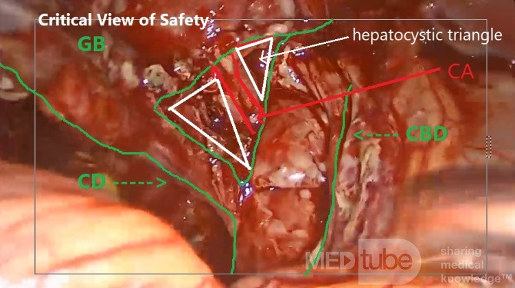 Critical View of Safety in LC
