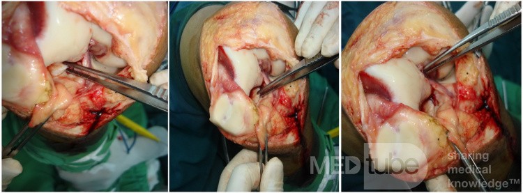 Osteochonderitis dissecans