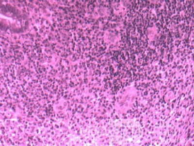 Multiple Rectal Ulcers (28 of 110)