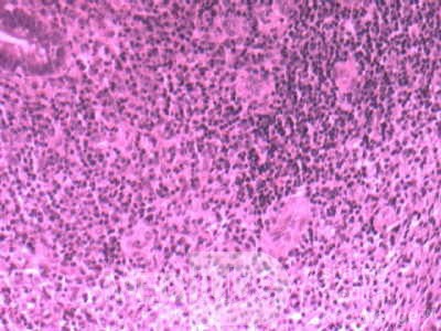 Multiple Rectal Ulcers (28 of 110)