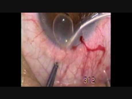 Fugo Blade for Glaucoma Surgery
