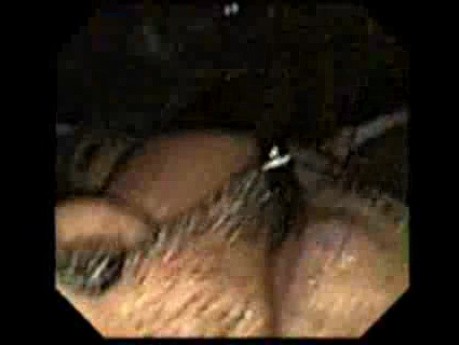Reterograde Endoscopy - The Endoscope Exits Through The Mouth - Endoscope's Flexibiliy