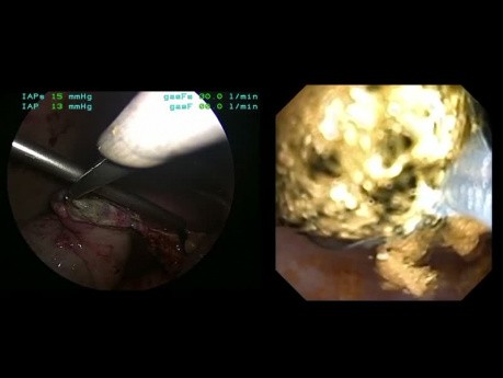 Laparoscopic CBD Exploration by the MIS Fellow With Removal of 45 Intra and Extra-hepatic Stones