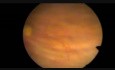 Transurethral Resection of Bladder Tumour - TURBT