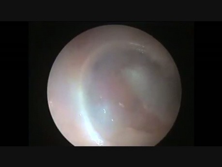Endoscopic Grommet Insertion