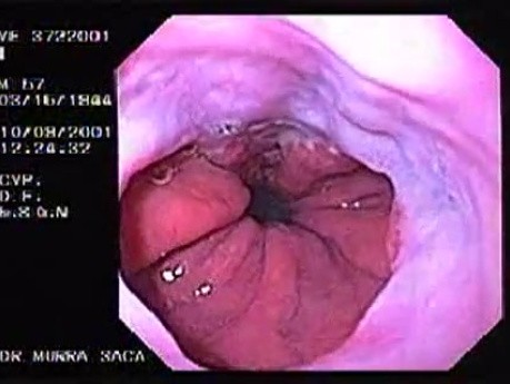 Sliding Hiatal Hernia