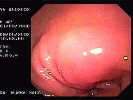 Gastric Ulcer of Pre-pyloric Antrum (2 of 2)