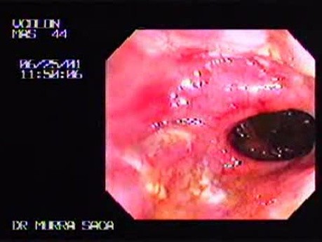 Confluent Ulcers