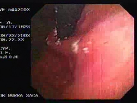 Esophageal Achalasia -  Retroflexed View of the Fundus