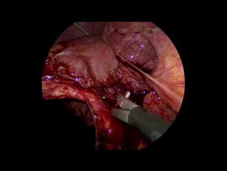 Laparoscopic Cholecystectomy for Acute Calculous Cholecystitis with Cirrhotic Liver and Portal Hypertension s/p Percutaneous Cholecystostomy
