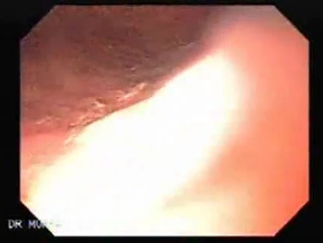 Synchronous Cancer Gastric and Esophageal (4 of 9 )
