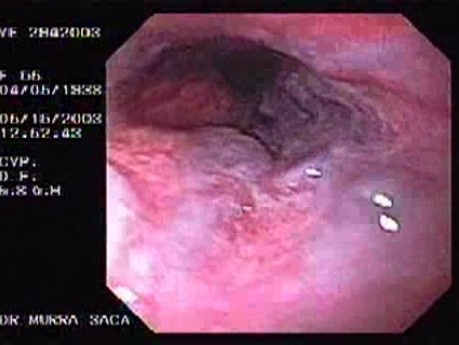 Banding of Esophageal Varices - Red Brillant Varices of the Cardias