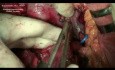 Pancreaticoduodenectomy for primary locally advanced adenocarcinoma of duodenum