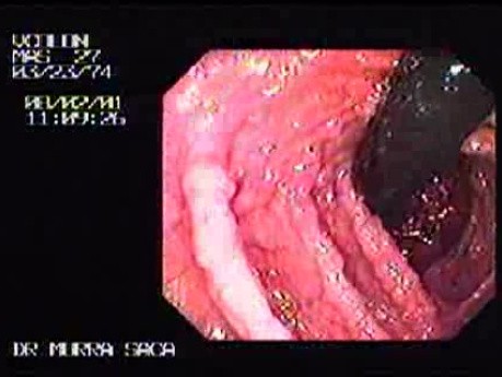 Familial Adenomatous Polyposis of the Colon (7 of 29)