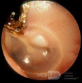 Cholesteatoma Left Ear