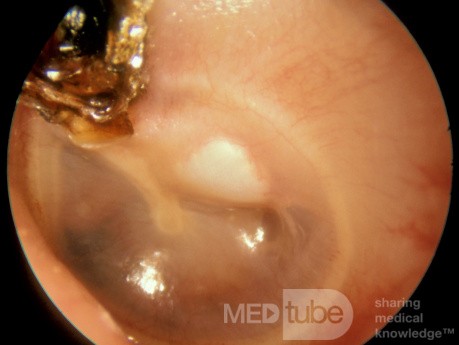 Cholesteatoma Left Ear