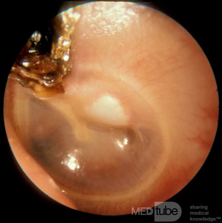 Cholesteatoma Left Ear
