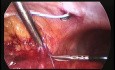 Retrocaval Ureter: Laparoscopic Transpositioning of Retrocaval Ureter and Ureteroureteric Anastomosis