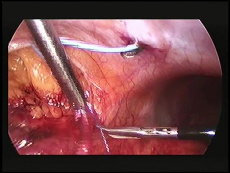 Retrocaval Ureter: Laparoscopic Transpositioning of Retrocaval Ureter and Ureteroureteric Anastomosis
