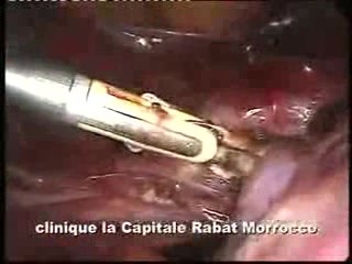 Eragon Bipolar Scissors And Laparoscopic Hysterectomy
