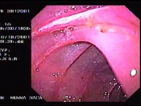 Ulcer at Anastomosis of a Billorth II Gastrectomy (4 of 4)