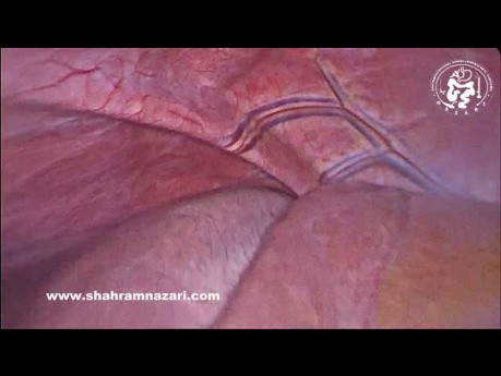 Accessory Grooves on the Diaphragmatic Surface of the Liver