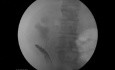 Malignant Ureteral Obstruction - Ureteral Stenting