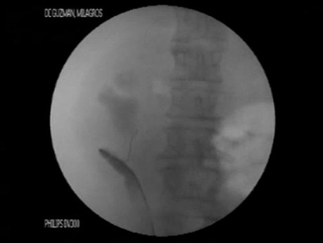 Malignant Ureteral Obstruction - Ureteral Stenting