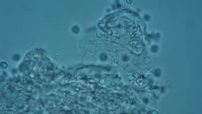 Cerebrospinal fluid (CSF) - Candidiasis
