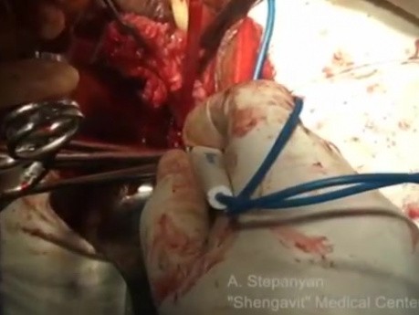 Vaginal Hysterectomy Morcellation