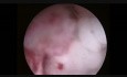 Histeroscopy Case - Pre-Menopausal Bleeding