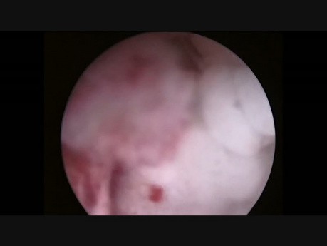 Histeroscopy Case - Pre-Menopausal Bleeding