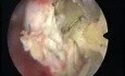 New Resection Master Systeme And Intrauterine Myoma