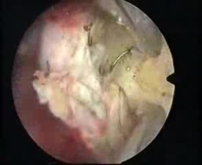 New Resection Master Systeme And Intrauterine Myoma